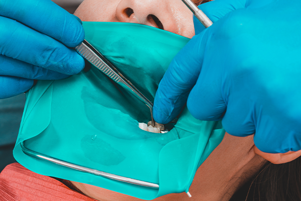 Zimmer Dental Spline (ドイツ・アメリカ製)